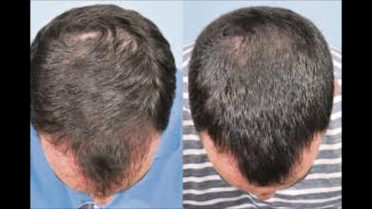 Minoxidil Topiskt för Alopecia Areata: Kan det hjälpa?